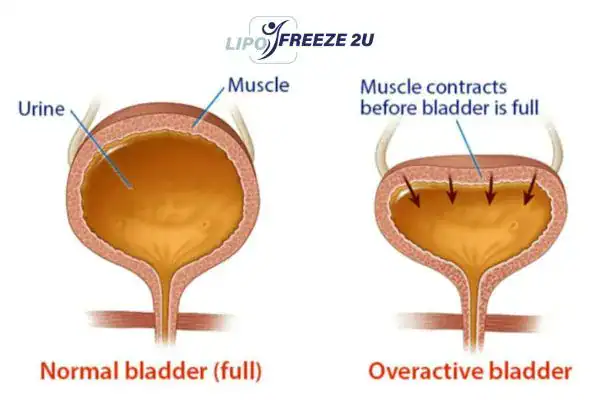 diagram of overactive bladder treatment Harwich