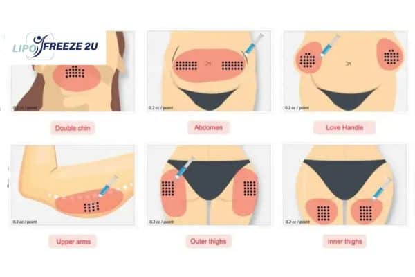 Benefits of Choosing Aqualyx for Fat Reduction Harwich