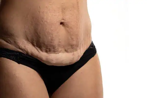 loose skin after weight loss injections Harwich
