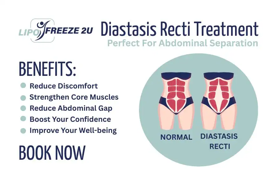 How Long Will It Take to See Improvements in Diastasis Recti Harwich