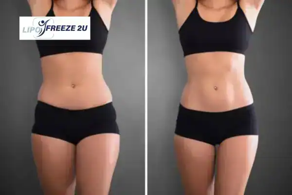How Can LIPO FREEZE 2U Support Your Post-Pregnancy Body Recovery Harwich?