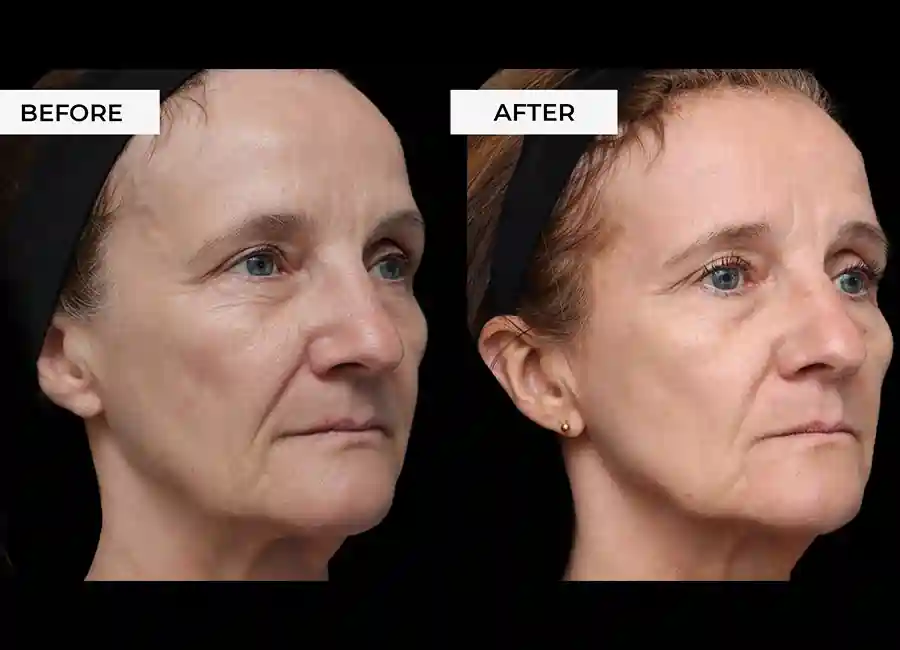 How Many RF Microneedling Sessions Will You Need to See a Difference Harwich?