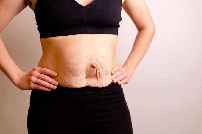 Is Surgery Really the Only Way to Repair Diastasis Recti Harwich?
