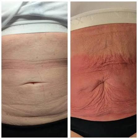 How Does RF Microneedling Improve Crepey, Thin and Uneven Skin Texture Harwich?