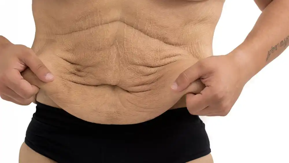 Why Does Weight Loss Medication Leave Some People With Loose or Sagging Skin Harwich?